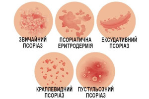 Види псоріазу